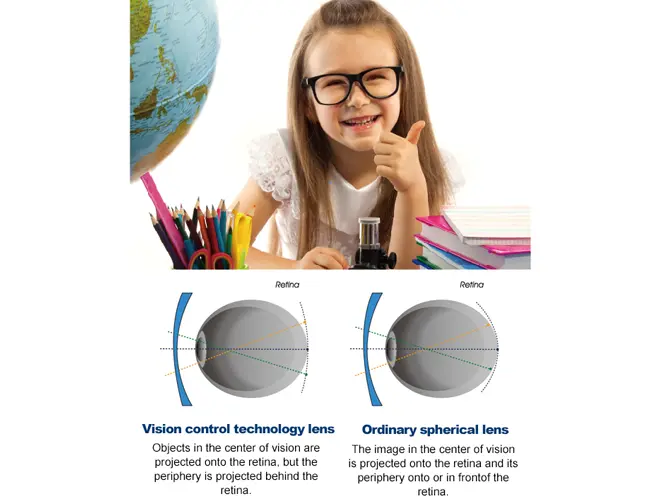 Periphere Defokuslinsen myovision-defocus-kids-myopia-control-single-vision-lens-1
